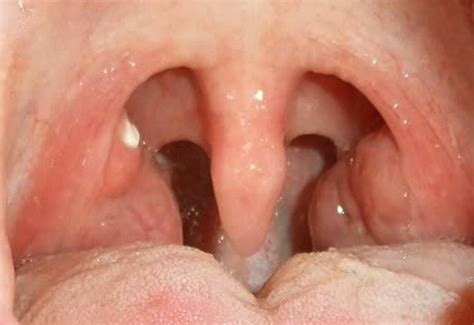 White Spot On Tonsil Pictures Causes Treatment Home Remedies