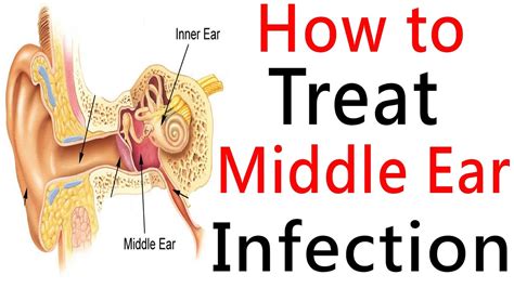 Middle Ear Infection And Middle Ear Effusion Causes And Treatment