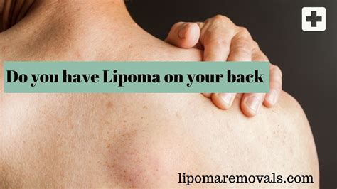 Removal Lipoma Removal Lipoma Treatment Surgery