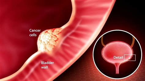 What Is Bladder Cancer Video Dailymotion