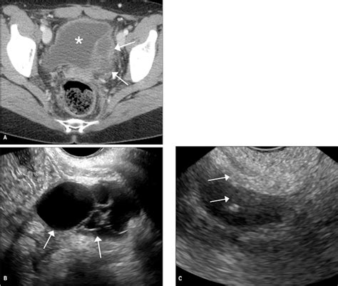 transvaginal ultrasound‐guided biopsy of deep pelvic masses plett 2016 journal of