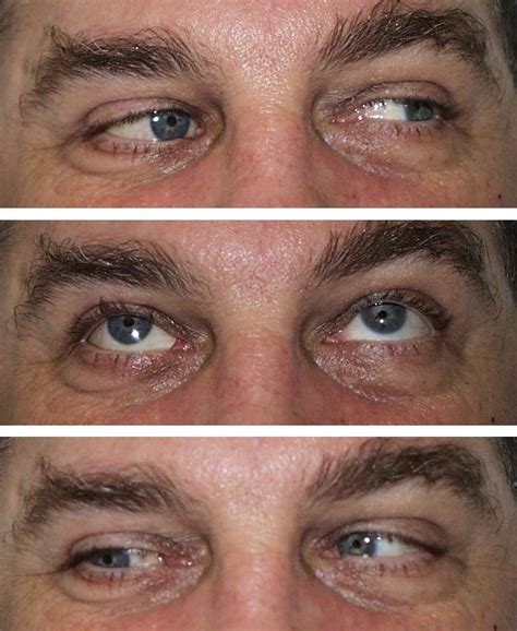 Prosthetic Eye Movement With Peg Integration Ocular Prosthetics Inc