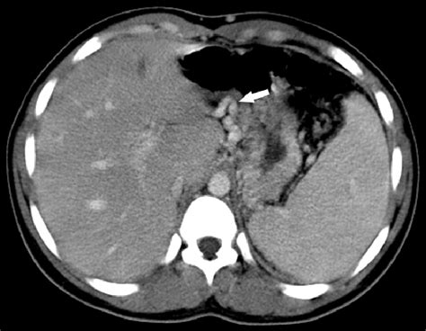 Abdominal Ct Showing Splenomegaly And Rich Peri Gastric Collateral