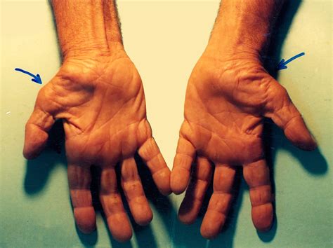 Carpal Tunnel Syndrome Causes Homeopathic Treatment