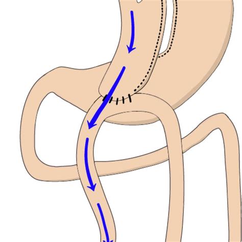 One Anastomosis Gastric Bypass Oagb Oagb Entails The Creation Of A