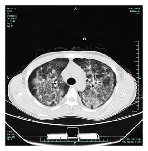The Chest Images Of Computed Tomography Ct Scan In The Aids Pcp