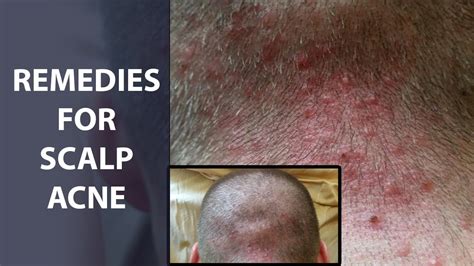 Home Remedies To Get Rid Of Scalp Acne Remedies For Scalp Acne Youtube