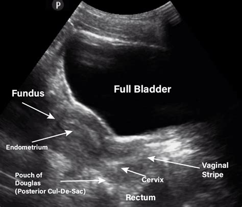 What Is A Pelvic Ultrasound