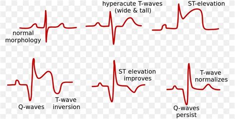 Acute St Elevation Myocardial Infarction