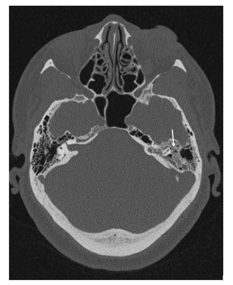 Cureus Cerebral Sinus Venous Thrombosis In The Setting Of Acute