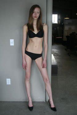 Starving For An Image The Issue Of Super Skinny Models Global