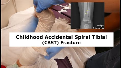 Childhood Accidental Spiral Tibial Cast Fracture Youtube