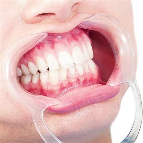 Standard Dental Mouth Opener Cheek And Lip Retractor Clear Size Buy Standard Dental