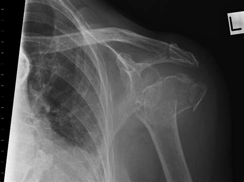 Transthoracic Lateral Shoulder Wikiradiography