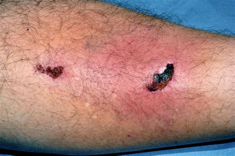 Cellulitis Following Leg Injury Photograph By Dr P Marazziscience