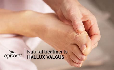 Hallux Valgusbunion And Its Natural Treatments Epitact