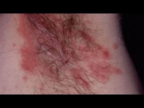 How To Get Rid Of An Armpit Rash Fast How To Cure Armpit Rash At Home