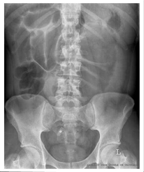 Dilated Small Bowel Loops On The Plain Abdominal X Ray Download Scientific Diagram