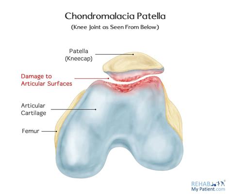 Chondromalacia Softened Cartilage Chondromalacia Knee Joint Cartilage