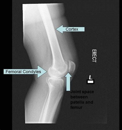 Lateral Radiograph Of Knee Radiography Medical Research Radiographer