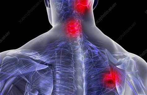 Pain Of The Neck And Shoulder Stock Image C0080915 Science Photo