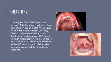 Ppt Hpv Genital Wartscancer Powerpoint Presentation Free Download Id2455673