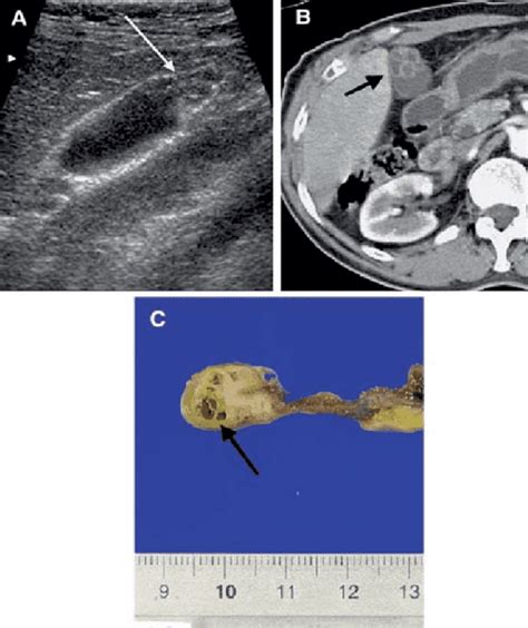 Gallbladder Adenomyomatosis Imaging Findings Semantic Scholar