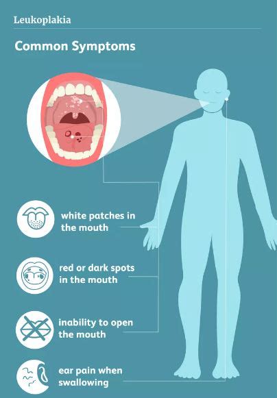 Symptoms Causes And Treatments Of Oral Leukoplakia Sabka Dentist