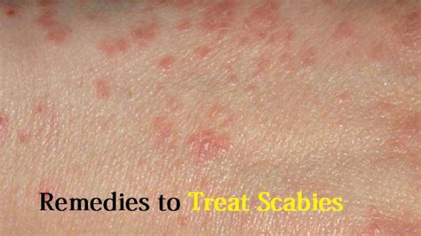 Scabies Rashes Images
