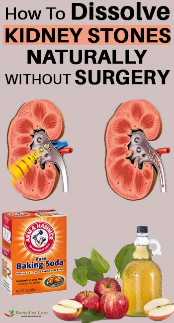 If the condition persists, you must visit your doctor. How To Dissolve Kidney Stones Naturally Without Surgery ...