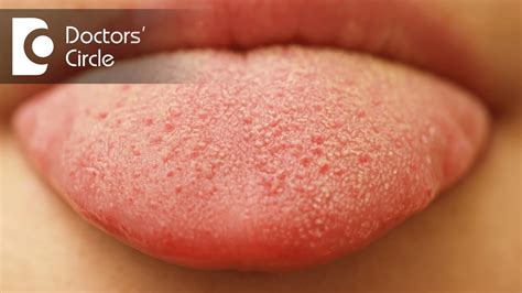What Causes Small Red Patches On Tongue Dr Sana Taher Youtube