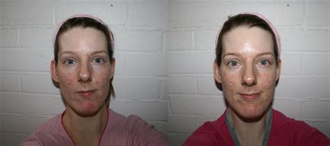 Pulsed Dye Laser Before And After Beauty Geek Uk