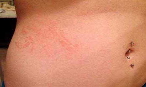 Scabies Rash Look Like And Causes9
