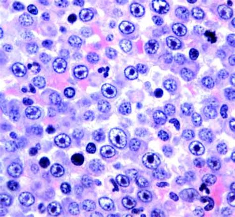 Learn more about the symptoms, causes, diagnosis, risk factors, and treatment of multiple myeloma. Medical Pictures Info - Multiple Myeloma