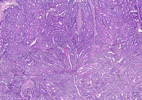 Pathology Outlines Endometrioid Carcinoma