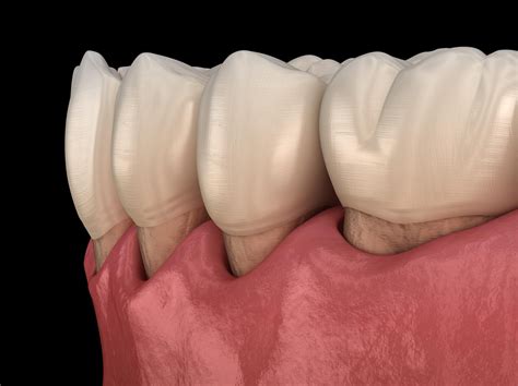 What Is A Gumline Cavity West Palm Beach Dentist