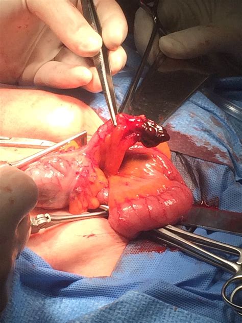 De Garengeot Hernia: A Case of Incarcerated Femoral Hernia Containing the Appendix | Surgical 