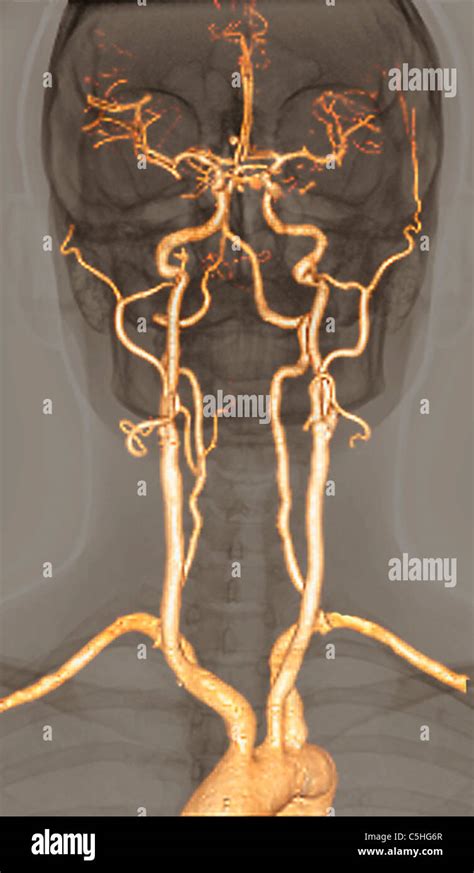 Normal Arteries 3d Ct Scan Stock Photo Alamy