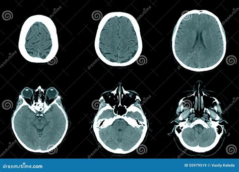 Normal Head On Ct Scans Stock Image Image Of Monochrome 55979519