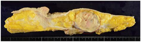 Recurrent Malignant Phyllodes Tumor Of The Breast An Extremely Rare