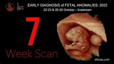 7 Week Scan In Fetal Medicine Early Fetal Scan Conference 2022 Youtube