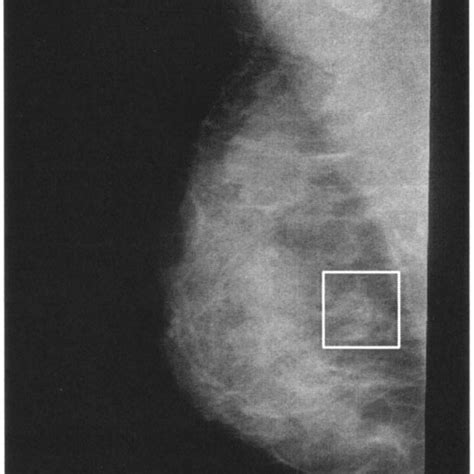 Microcalcification Cluster Marked In The Mammogram Shown In Fig 1 The