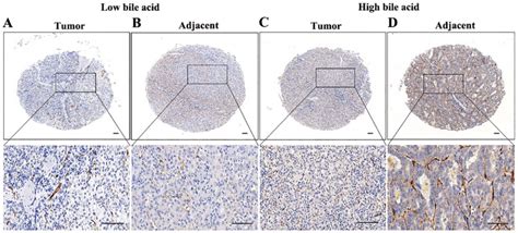 Immunohistochemical Staining Of Cd34 In Patients With Hcc Tumor And