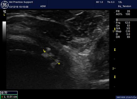Sonographic Features Of Shoulder Osteochondrosis Dissecans Ocd In A