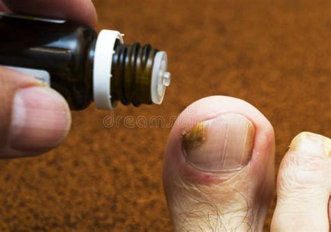 Toe And Nail Fungus Dermatologist The Doctor Treats The Patient S