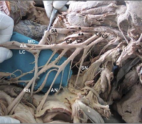 Brachial Plexus And Anterior Scalene Muscle In Ventral View Left Download Scientific Diagram