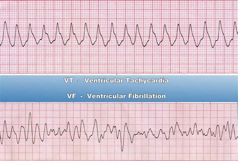 Images Of Ventricular Tachycardia
