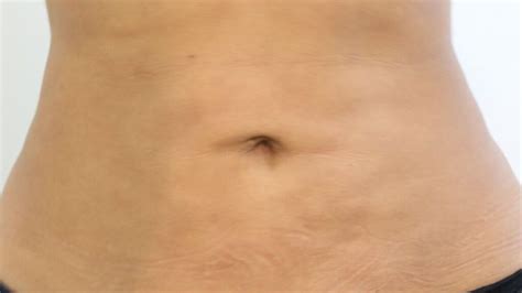 Fibrosis After Lipo