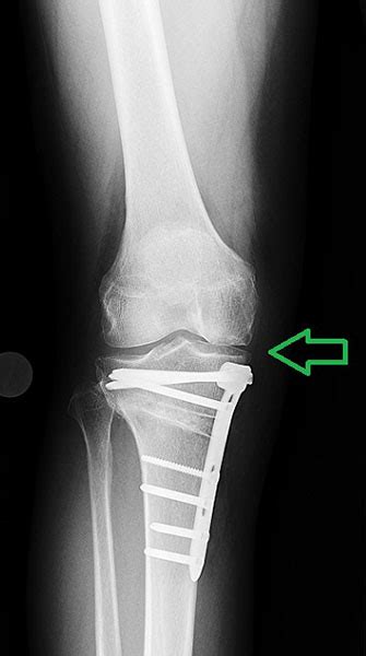 Knee Realignment And Joint Preservation Prox Tibial Osteotomy