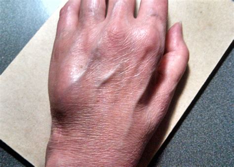 A 55 Year Old Woman With Persistent Wrist Pain Jbjs Image Quiz